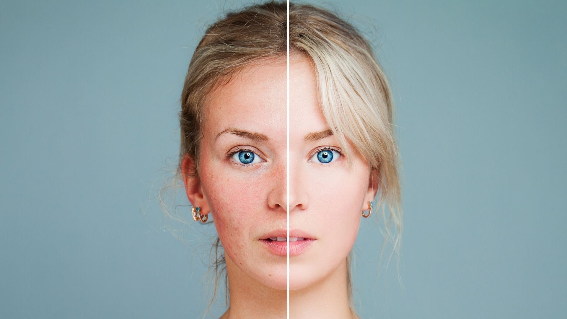 Stades et niveaux acne